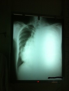 Chest x-ray 002